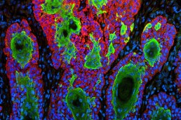 Estudio proteogenómico en carcinoma de células escamosas de cabeza y cuello HPV-negativo