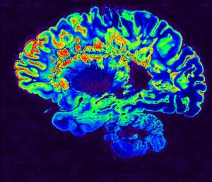 Mejora en la clasificación de la enfermedad de Alzheimer gracias a la inteligencia artificial